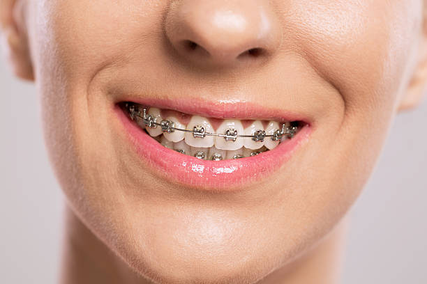 Unlocking Your Best Smile: The Journey with San Fernando Valley Braces